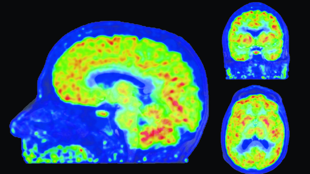 Νέα μέθοδος απεικόνισης του εγκεφάλου δείχνει που απενεργοποιούνται γονίδια