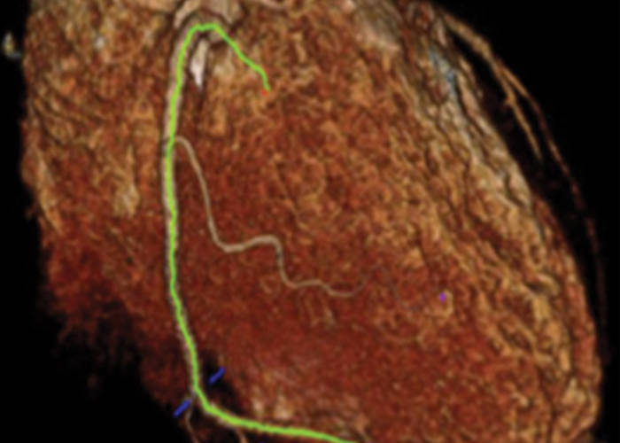 Νέα, μη επεμβατική τεχνική απεικόνισης εντοπίζει καρδιακή νόσο πριν τα συμπτώματα